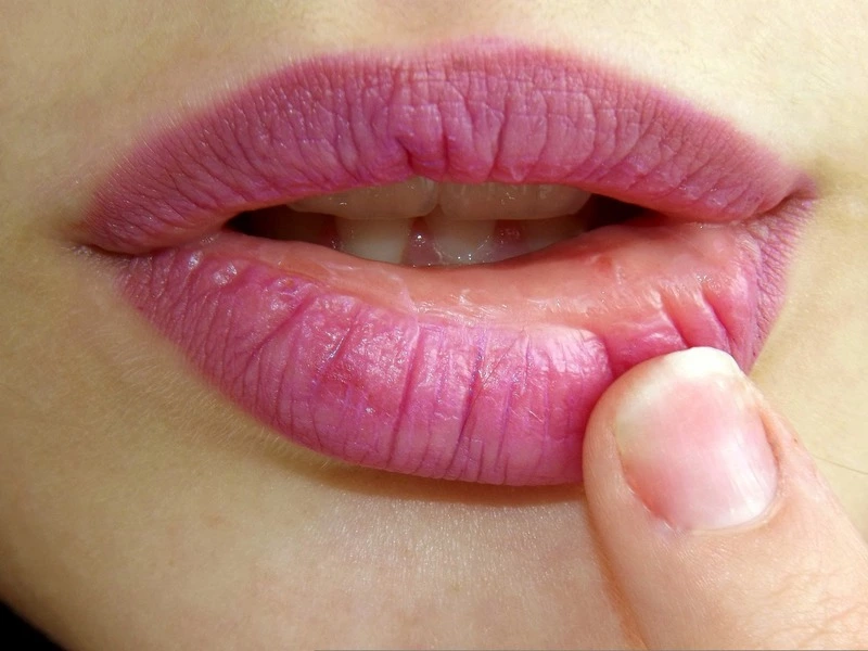 Cara mengatasi bibir bengkak