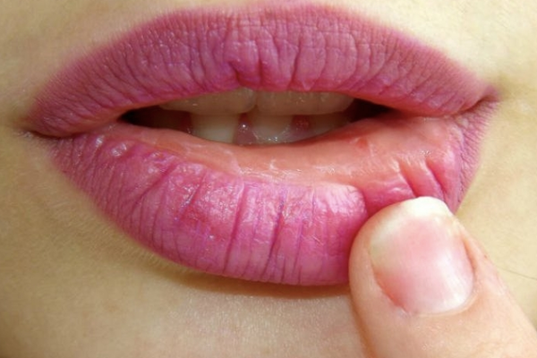 cara mengatasi bibir bengkak